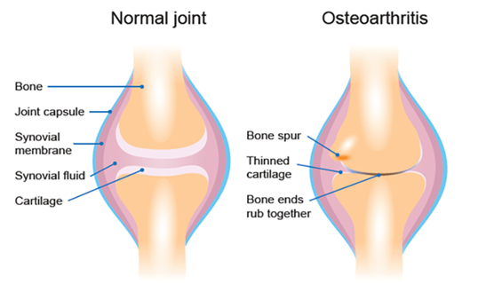 Osteoarthritis (OA)