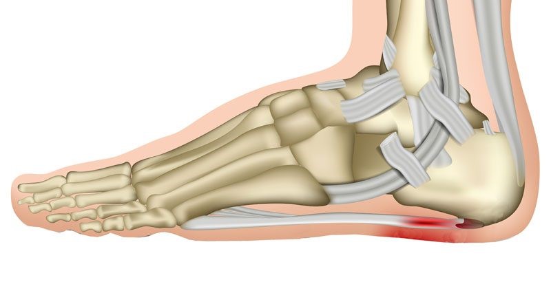 What is Plantar Fasciitis?